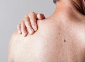 mans back with Melanoma