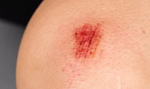 picture of abrasion